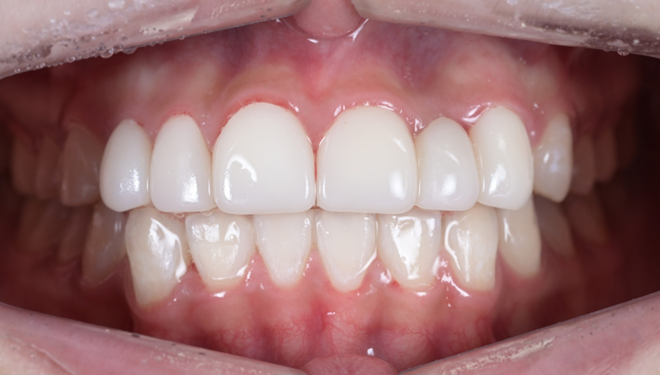 왜소치, 결손치가 동시에 있었던 환자의 앞니 심미보철 관련 이미지 11
