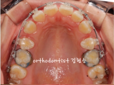 강남치아교정추천 관련 이미지 27