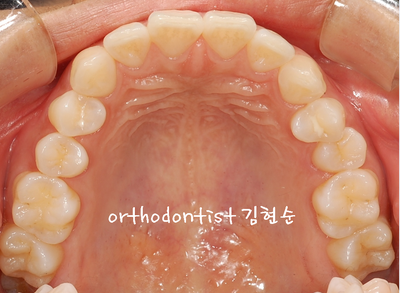 돌출 교정 (비발치 교정/비대칭) 관련 이미지 5