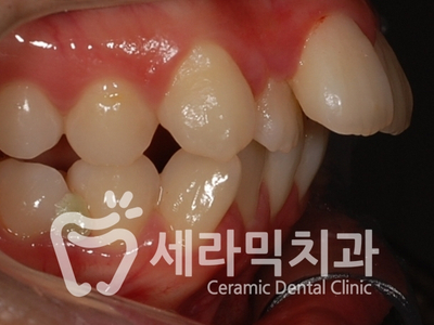 치아교정 전후 스마일라인 변화!(돌출입,토끼앞니, 중심선 비대칭 동시 교정) 관련 이미지 9
