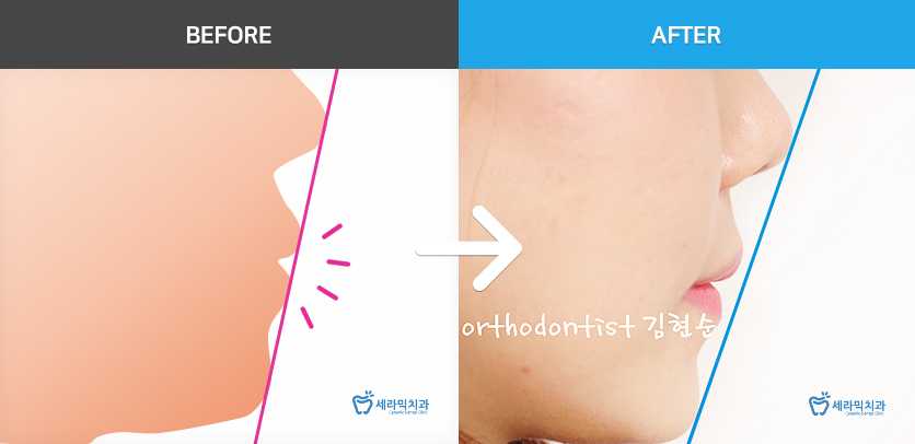 학동역치과 미국3M교정 추천 ~~ 관련 이미지 12