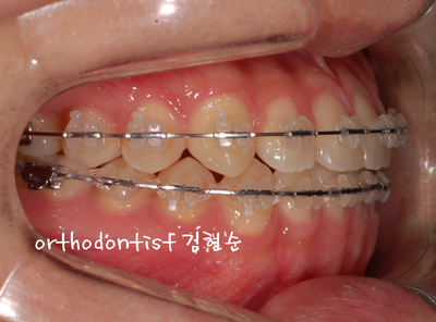 반대 교합 관련 이미지 21