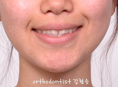 강남 돌출입 교정 관련 이미지 2