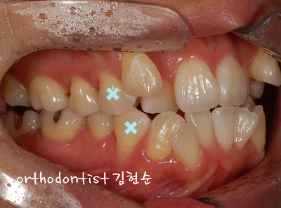 강남 덧니 관련 이미지 13