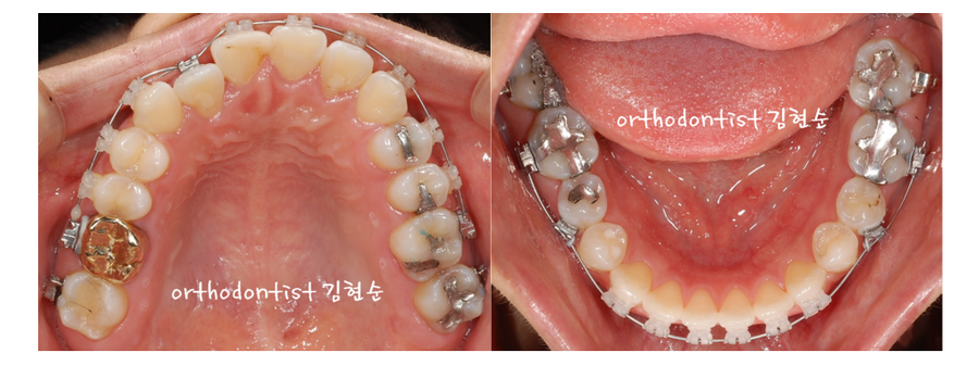 안면비대칭 교정, 치아교정만으로 간단히 해결하기 관련 이미지 10