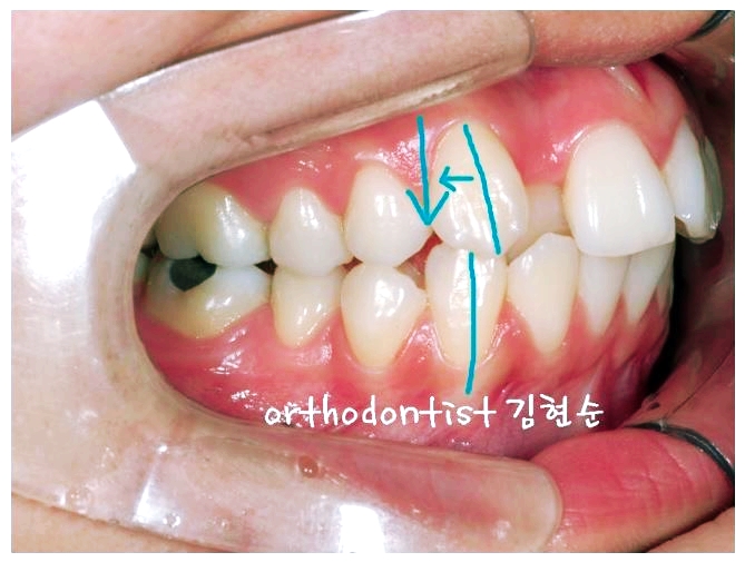 돌출입 교정 실패 그 후 ~ 관련 이미지 6