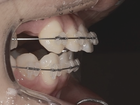 학동역치과 하면 세라믹교정 ~ 관련 이미지 20