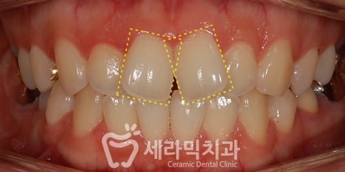 벌어진 나비치아 돌출입 치아교정전후 관련 이미지 2