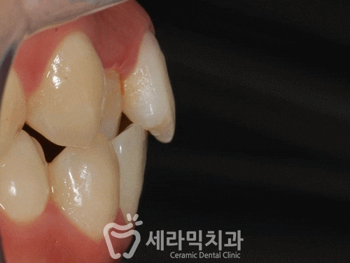 돌출입, 치열불규칙, 치아상실 치아교정과 임플란트 전후 관련 이미지 6