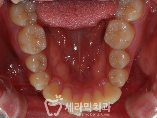 치아배열 치아교정전후 : 함박웃음을 찾은 사례 관련 이미지 5