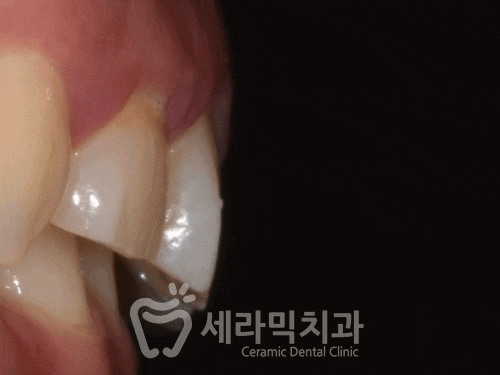 과개교합, 거미스마일, 치아 벌어짐까지 한번에! 치아교정전후 살펴보기 관련 이미지 4