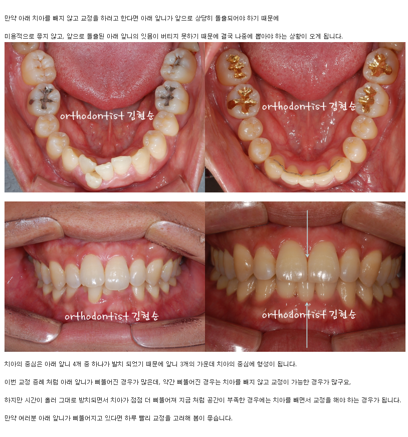 들쑥날쑥한 아래 앞니, 발치 후 교정 관련 이미지 6