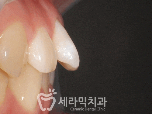 돌출입과 과개교합, 중심선 불일치, 치열불규칙 치아교정전후사진 관련 이미지 8