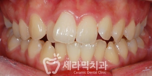 삐뚤빼뚤 치열불규칙 치아교정전후 달라진 미소 관련 이미지 1