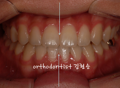 반대 교합 관련 이미지 30