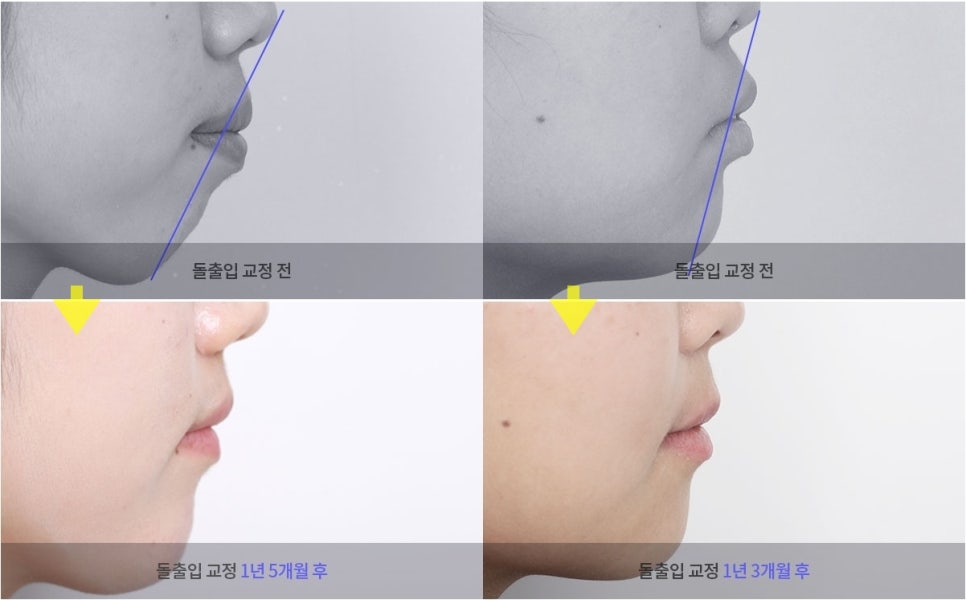 돌출입교정만 했을 뿐인데, 성형한 것처럼 달라진 인상! 관련 이미지 2