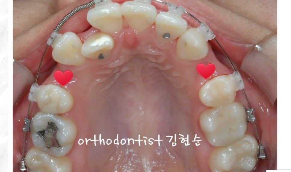 돌출입교정 / 기간 / 비용 관련 이미지 4