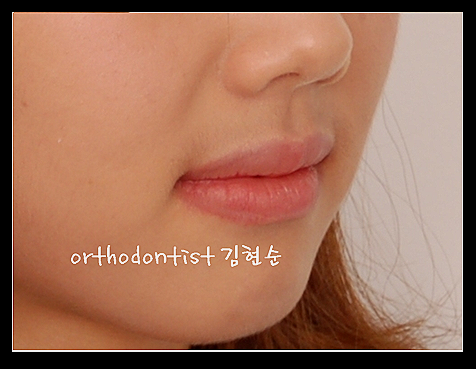 강남교정치과 관련 이미지 34