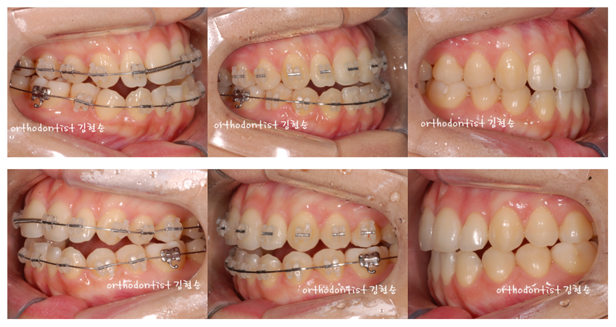 개방교합 비발치 세라믹교정 관련 이미지 11