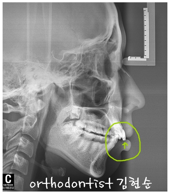 강남 돌출입 관련 이미지 4