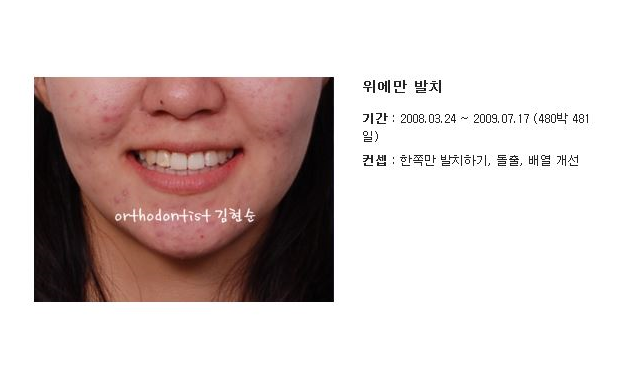 돌출입교정 / 기간 / 비용 관련 이미지 2