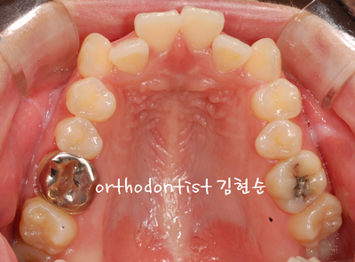 치열 교정(치열 불규칙) 관련 이미지 7