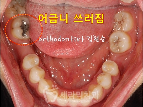 돌출입교정만 했을 뿐인데, 성형한 것처럼 달라진 인상! 관련 이미지 8