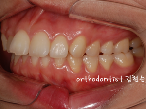 강남 돌출입 교정 관련 이미지 7