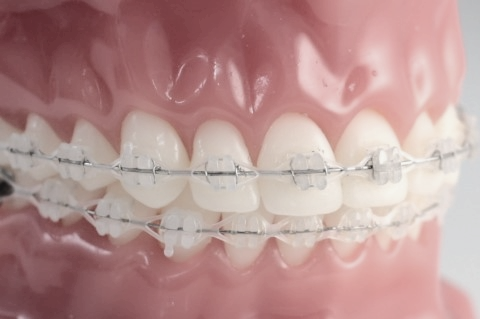 학동역치과 하면 세라믹교정 ~ 관련 이미지 12