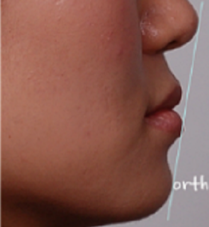 주걱턱수술 안하고 양악수술 안하고 관련 이미지 7