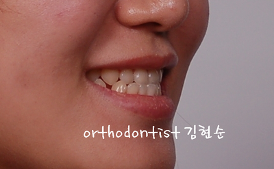 반대 교합 관련 이미지 4