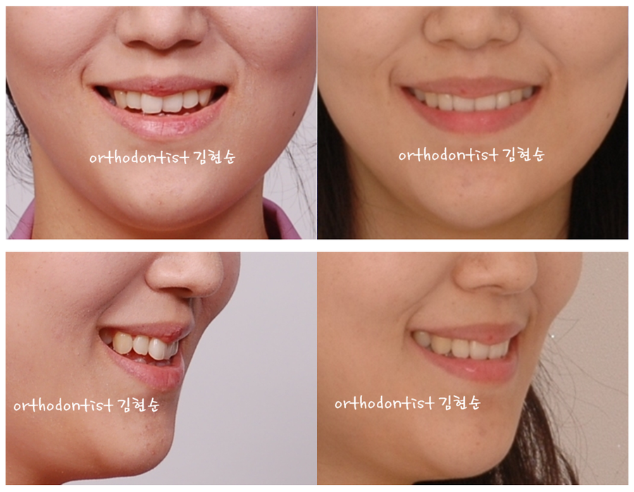 개방교합 비발치 세라믹교정 관련 이미지 15