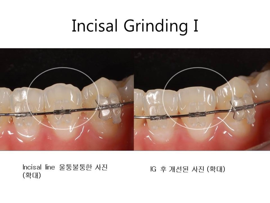 학동역치과 치아교정 잘하는 곳 ! 관련 이미지 29