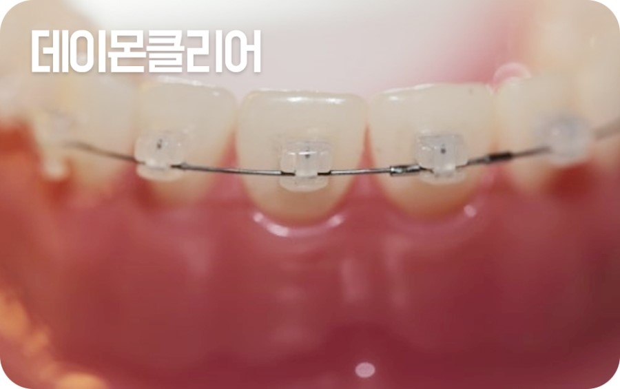 교정장치 구분하기 관련 이미지 6