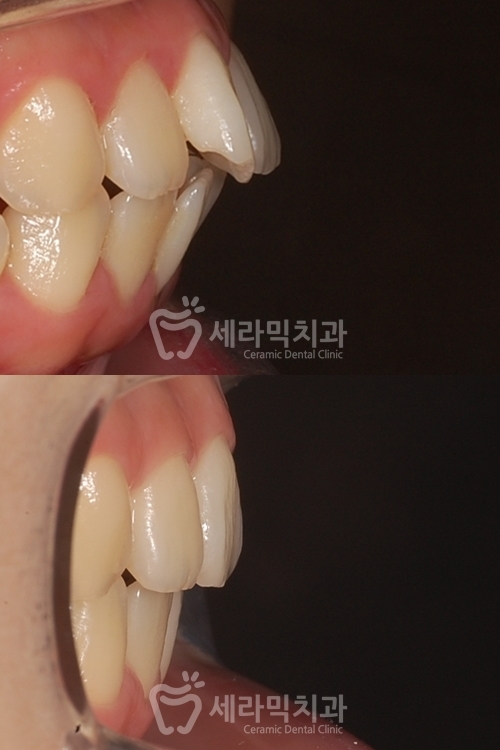 돌출입교정만 했을 뿐인데, 얼굴형과 무턱까지 개선된 치아교정전후 관련 이미지 6