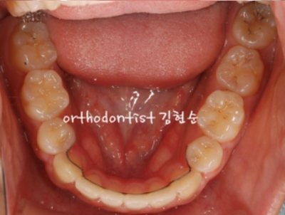 강남치아교정추천 관련 이미지 31