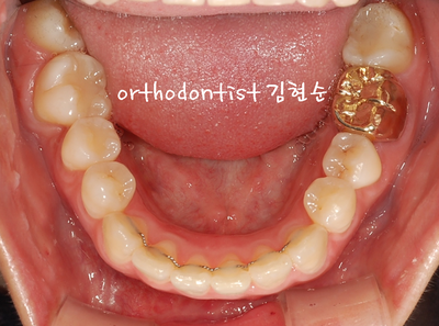 강남 덧니, 돌출 관련 이미지 27