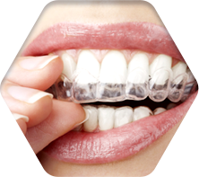 세라믹교정 세라믹치과  "투명교정"의 새이름 "3D미소교정" 관련 이미지 6