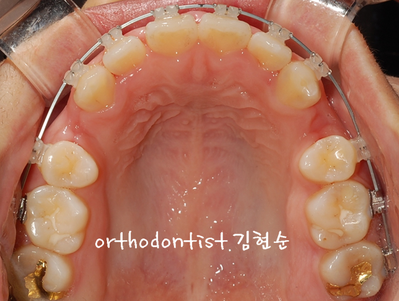 강남 돌출 관련 이미지 23