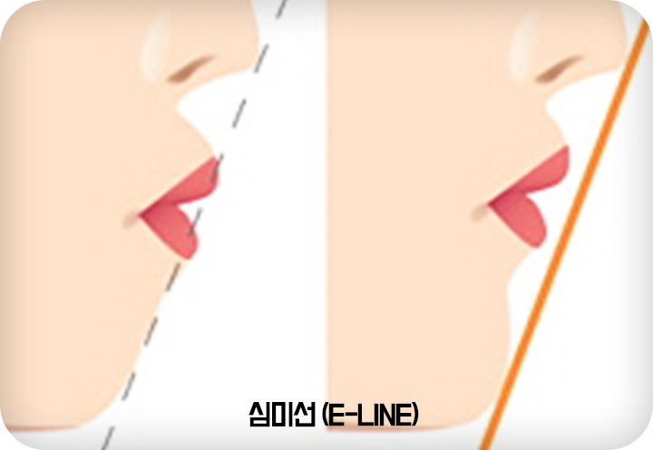 돌출입 비발치 치아교정 관련 이미지 2