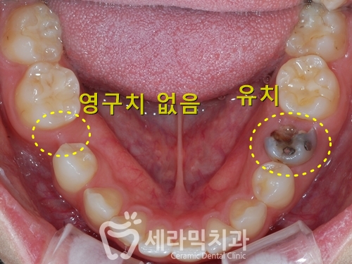나비치아, 앞니돌출, 과개교합 치아교정전후 관련 이미지 2