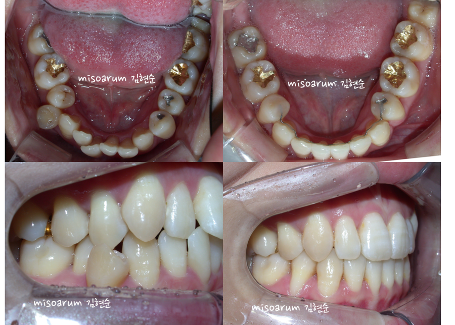 세라믹교정 덧니교정 관련 이미지 8
