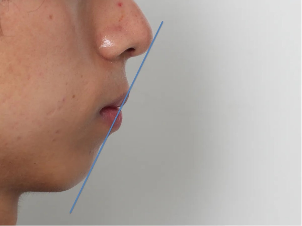 돌출입 교정 전후, 그런데 과개교합까지 있으셨던 환자분 관련 이미지 6