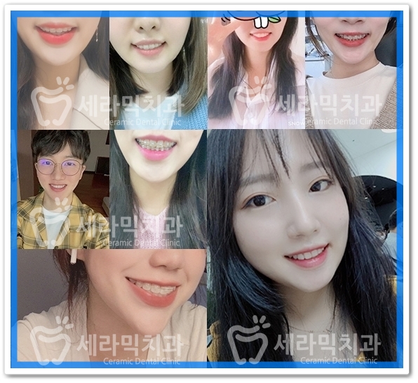 과개교합, 거미스마일, 치아 벌어짐까지 한번에! 치아교정전후 살펴보기 관련 이미지 9