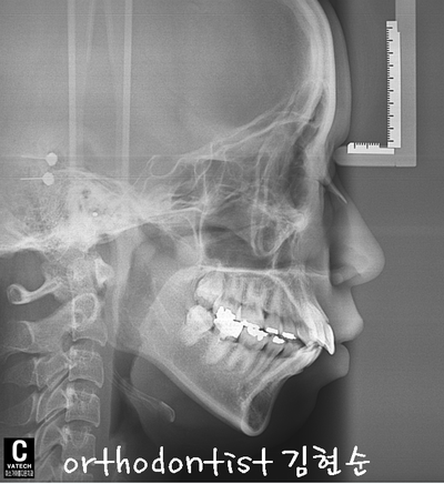 강남 돌출 관련 이미지 13