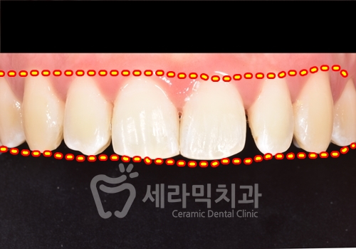 무삭제라미네이트 , 세라네이트가 궁금하다면? 관련 이미지 8