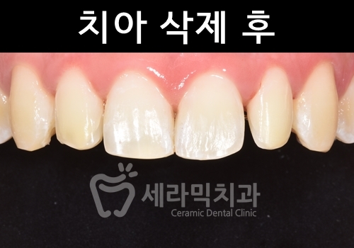 무삭제라미네이트 , 세라네이트가 궁금하다면? 관련 이미지 4