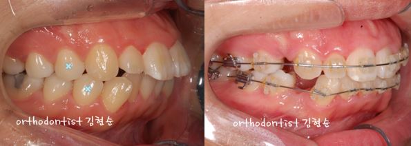 세라믹치과 "돌출입 발치교정" 관련 이미지 6
