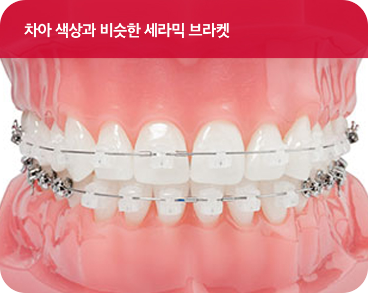 강남치아교정 브라켓비교분석 관련 이미지 3