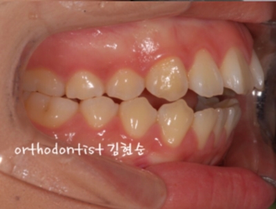 강남치아교정추천 관련 이미지 6